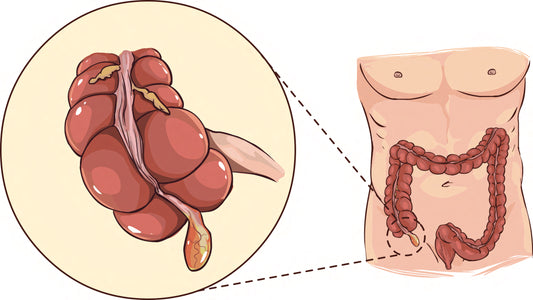 Appendicectomy Set (Laparoscopic)